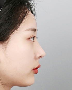 수술 후 측면