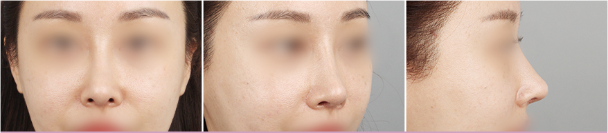 수술 후 3개월