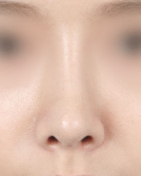 수술 후 3개월